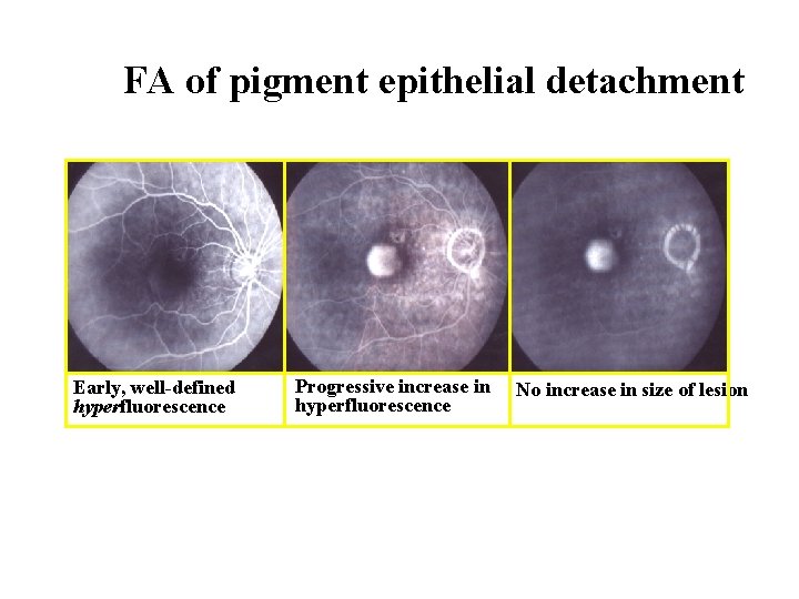 FA of pigment epithelial detachment Early, well-defined hyperfluorescence Progressive increase in hyperfluorescence No increase