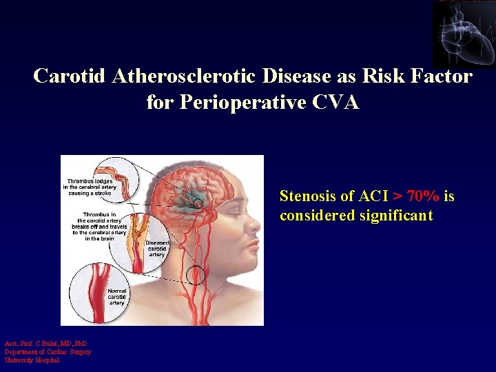 Carotid Atherosclerotic Disease as Risk Factor for Perioperative CVA Stenosis of ACI > 70%