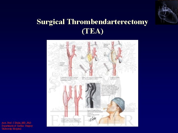 Surgical Thrombendarterectomy (TEA) Asst. Prof. C. Bulat, MD, Ph. D Department of Cardiac Surgery