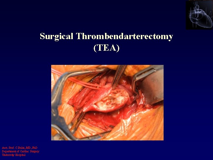 Surgical Thrombendarterectomy (TEA) Asst. Prof. C. Bulat, MD, Ph. D Department of Cardiac Surgery