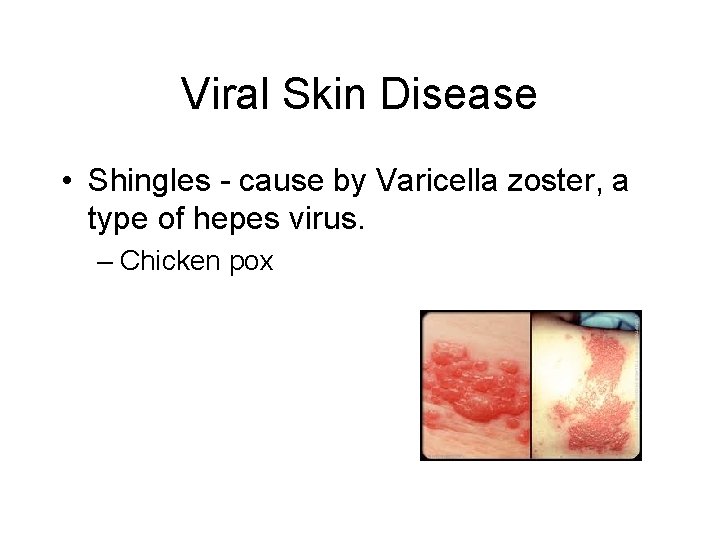 Viral Skin Disease • Shingles - cause by Varicella zoster, a type of hepes