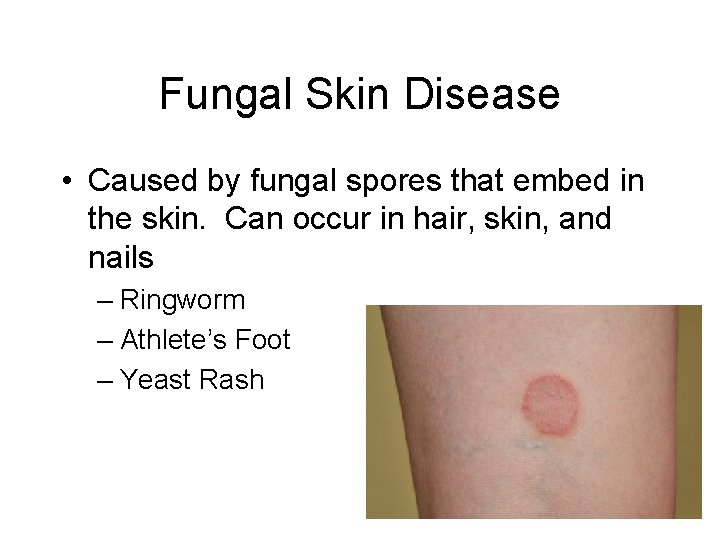 Fungal Skin Disease • Caused by fungal spores that embed in the skin. Can