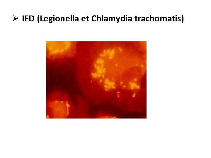 Ø IFD (Legionella et Chlamydia trachomatis) 