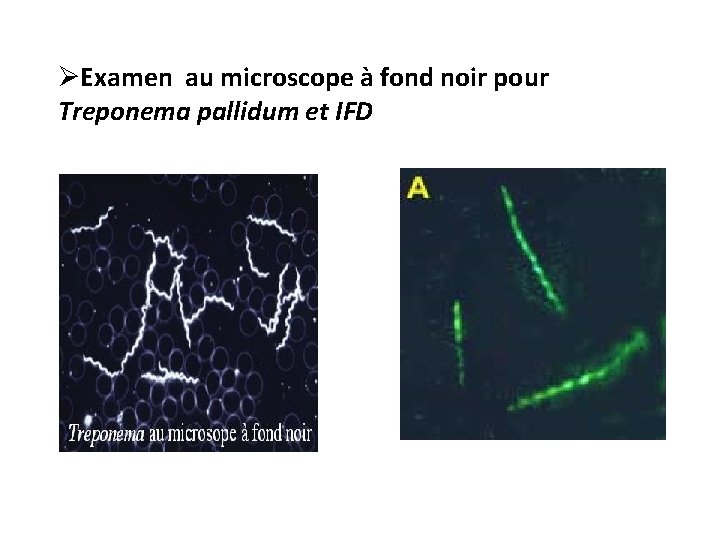 ØExamen au microscope à fond noir pour Treponema pallidum et IFD 