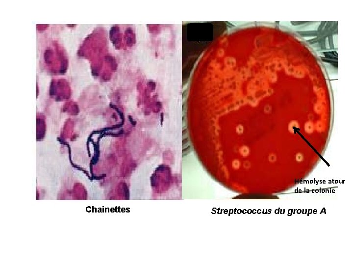 Hémolyse atour de la colonie Chainettes Streptococcus du groupe A 