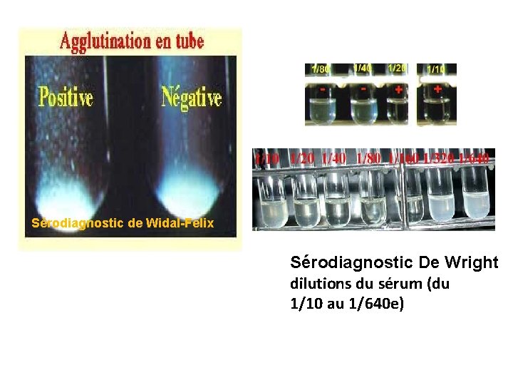 Sérodiagnostic de Widal-Felix Sérodiagnostic De Wright dilutions du sérum (du 1/10 au 1/640 e)