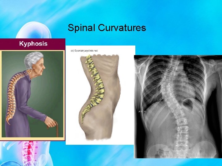 Spinal Curvatures 