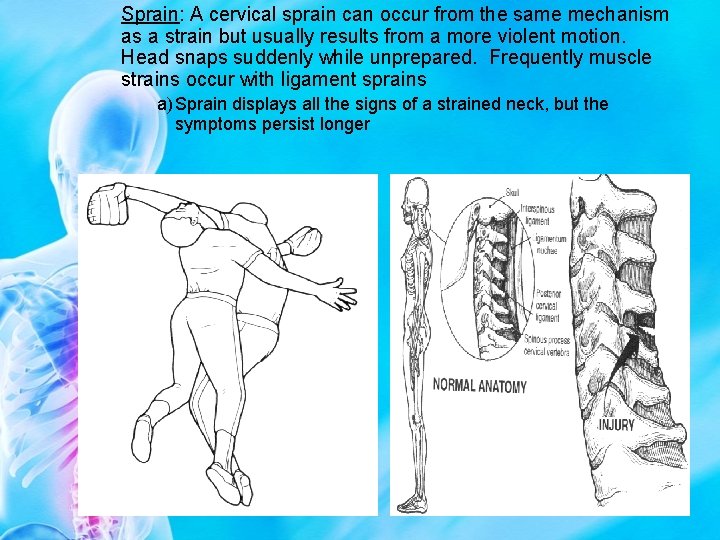 Sprain: A cervical sprain can occur from the same mechanism as a strain but