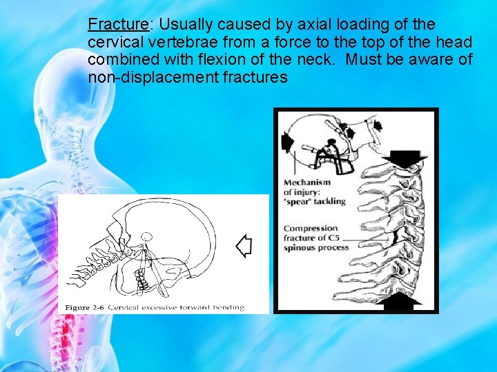 Fracture: Usually caused by axial loading of the cervical vertebrae from a force to