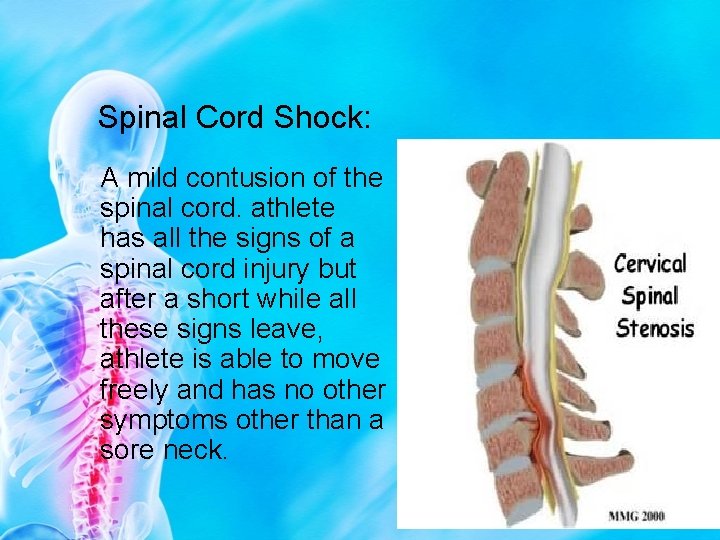 Spinal Cord Shock: A mild contusion of the spinal cord. athlete has all the