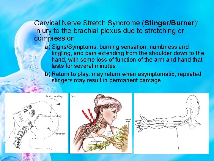 Cervical Nerve Stretch Syndrome (Stinger/Burner): Injury to the brachial plexus due to stretching or