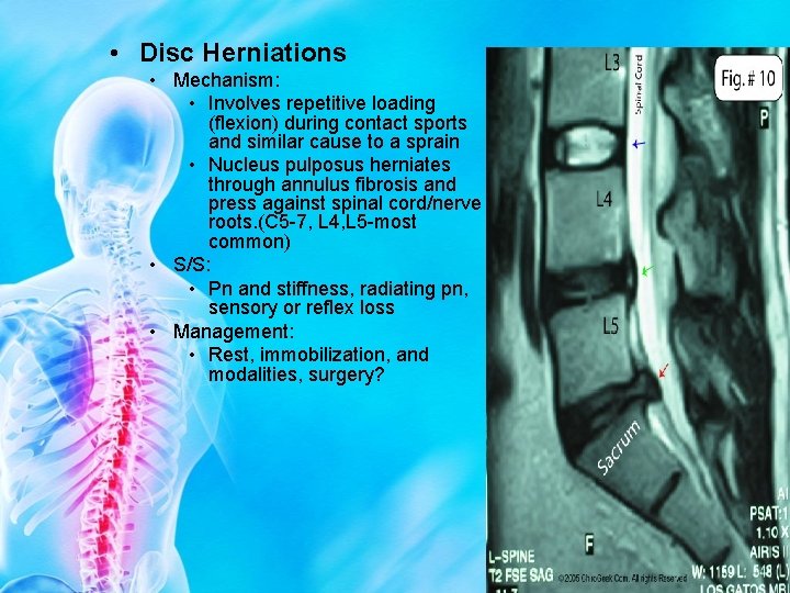  • Disc Herniations • Mechanism: • Involves repetitive loading (flexion) during contact sports