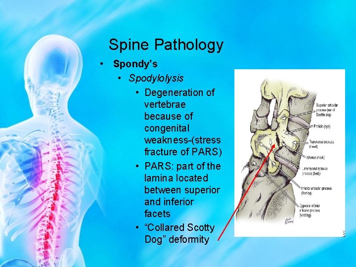 Spine Pathology • Spondy’s • Spodylolysis • Degeneration of vertebrae because of congenital weakness-(stress