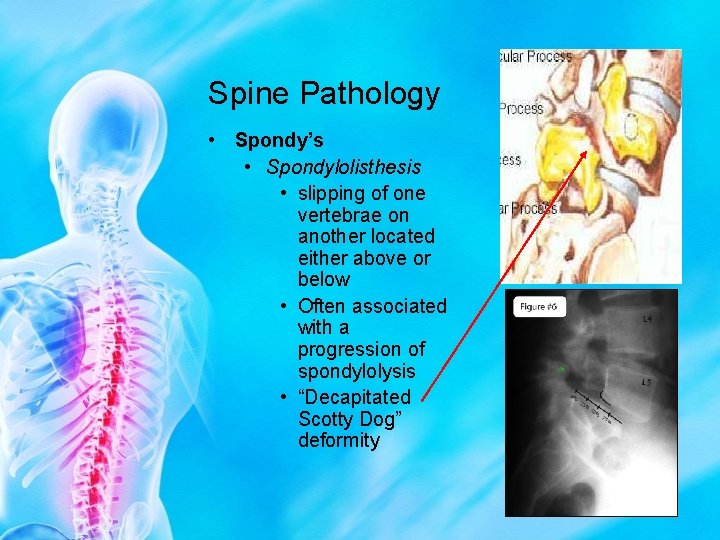 Spine Pathology • Spondy’s • Spondylolisthesis • slipping of one vertebrae on another located
