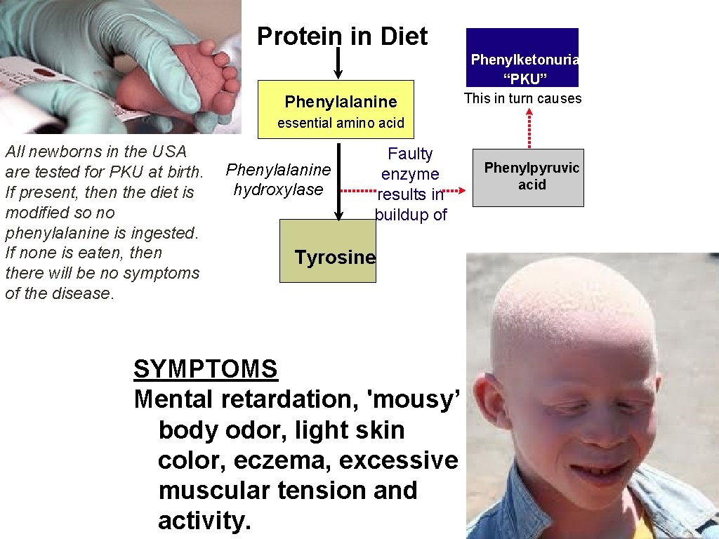Protein in Diet Phenylalanine Phenylketonuria “PKU” This in turn causes essential amino acid All