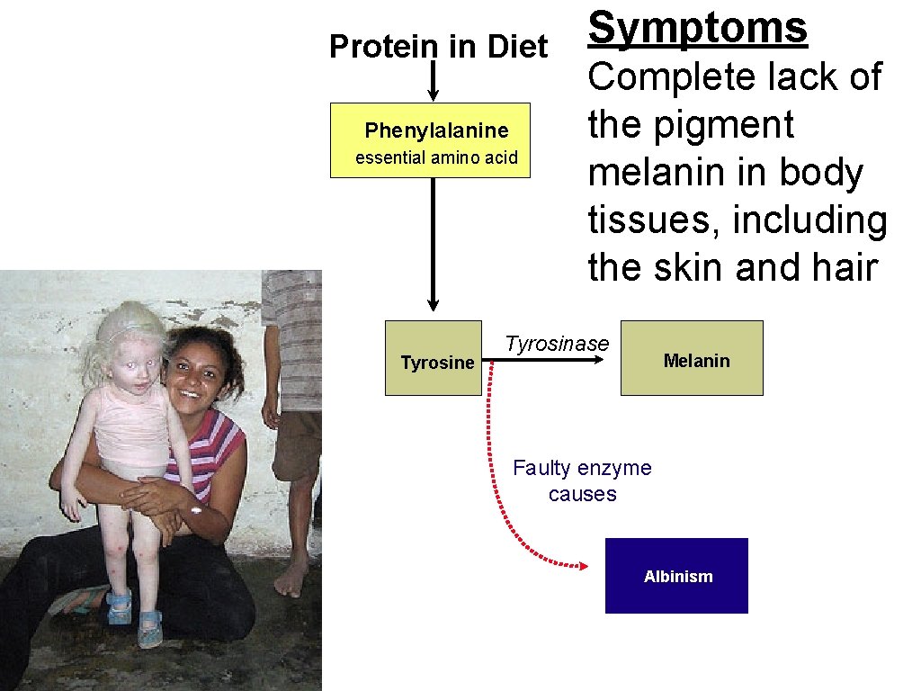 Protein in Diet Phenylalanine essential amino acid Tyrosine Symptoms Complete lack of the pigment