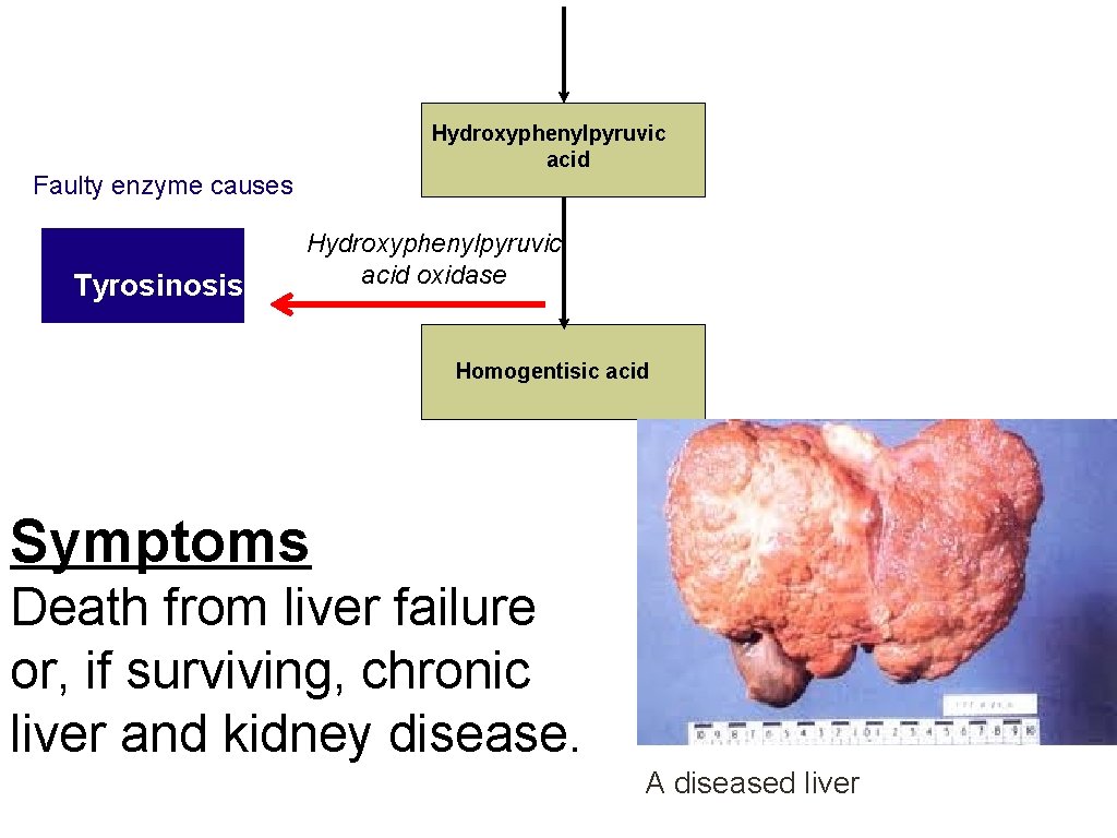 Hydroxyphenylpyruvic acid Faulty enzyme causes Tyrosinosis Hydroxyphenylpyruvic acid oxidase Homogentisic acid Symptoms Death from