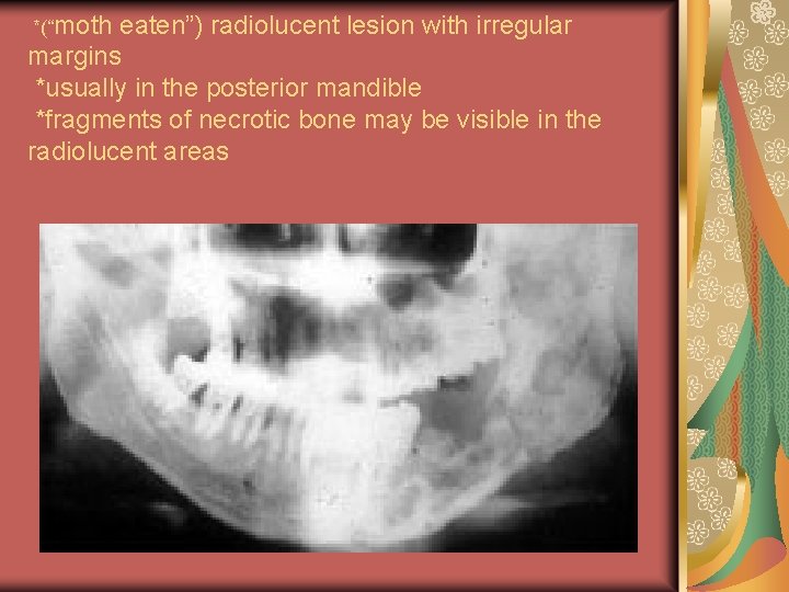 *(“moth eaten”) radiolucent lesion with irregular margins *usually in the posterior mandible *fragments of