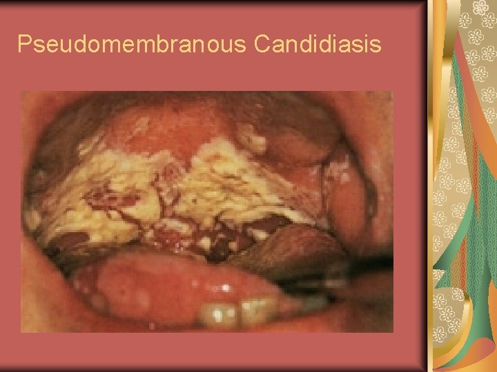 Pseudomembranous Candidiasis 