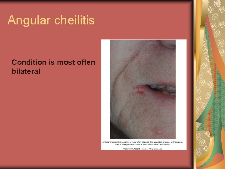 Angular cheilitis Condition is most often bilateral 