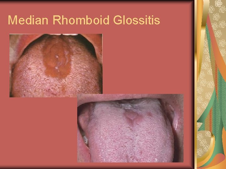 Median Rhomboid Glossitis 