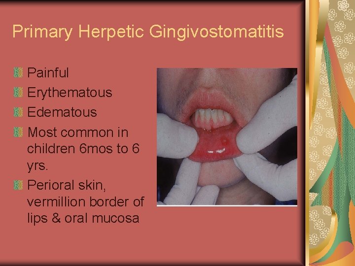 Primary Herpetic Gingivostomatitis Painful Erythematous Edematous Most common in children 6 mos to 6