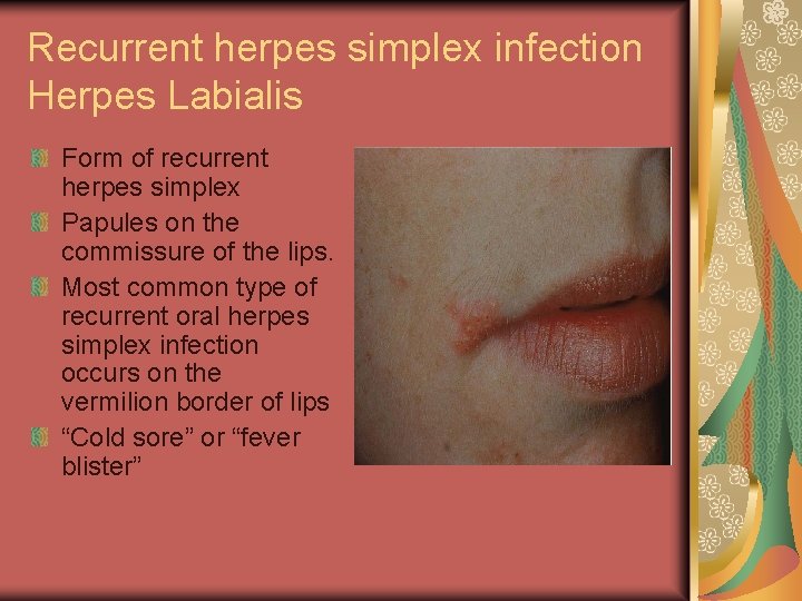 Recurrent herpes simplex infection Herpes Labialis Form of recurrent herpes simplex Papules on the