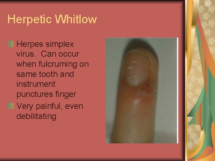 Herpetic Whitlow Herpes simplex virus. Can occur when fulcruming on same tooth and instrument