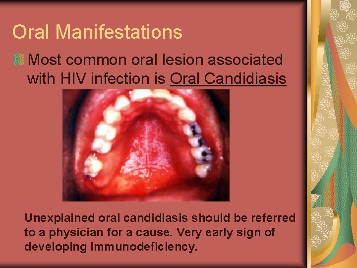 Oral Manifestations Most common oral lesion associated with HIV infection is Oral Candidiasis Unexplained