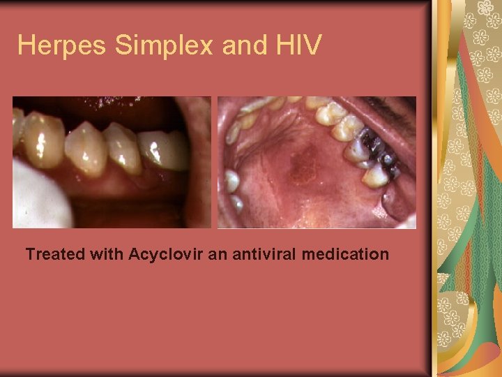 Herpes Simplex and HIV Treated with Acyclovir an antiviral medication 