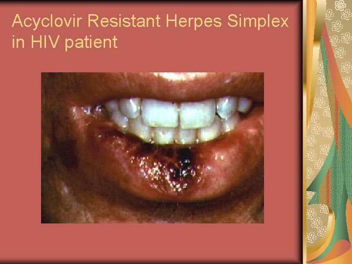 Acyclovir Resistant Herpes Simplex in HIV patient 