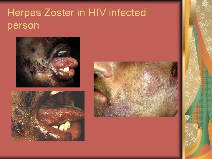 Herpes Zoster in HIV infected person 