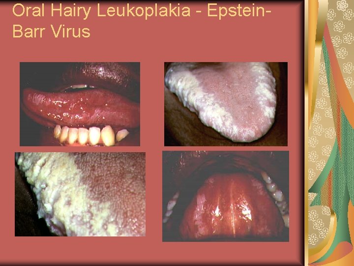 Oral Hairy Leukoplakia - Epstein. Barr Virus 