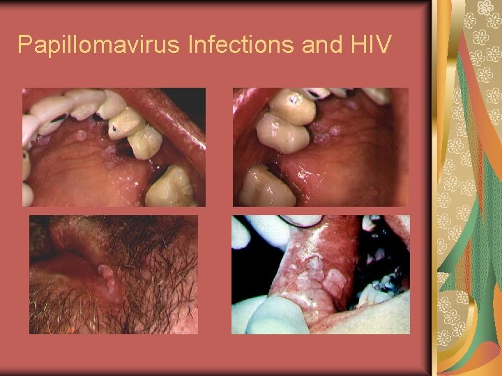 Papillomavirus Infections and HIV 