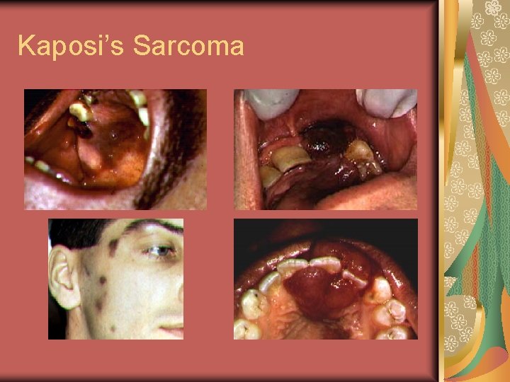 Kaposi’s Sarcoma 