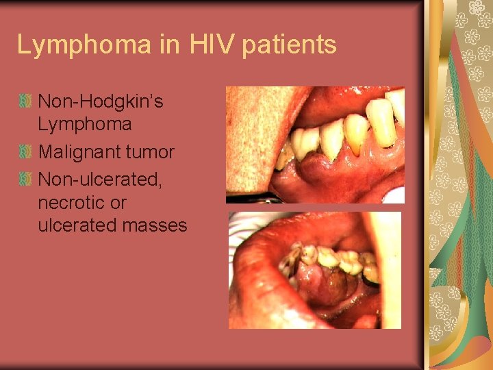 Lymphoma in HIV patients Non-Hodgkin’s Lymphoma Malignant tumor Non-ulcerated, necrotic or ulcerated masses 