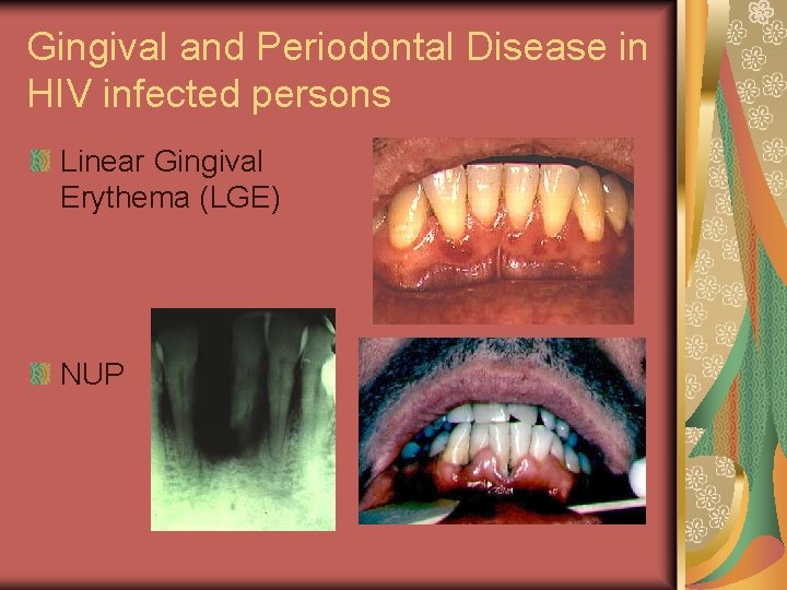 Gingival and Periodontal Disease in HIV infected persons Linear Gingival Erythema (LGE) NUP 
