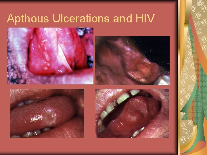 Apthous Ulcerations and HIV 