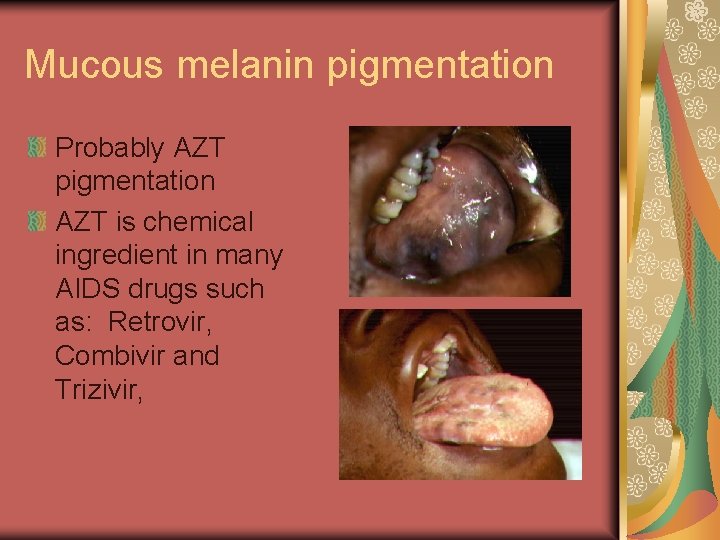 Mucous melanin pigmentation Probably AZT pigmentation AZT is chemical ingredient in many AIDS drugs