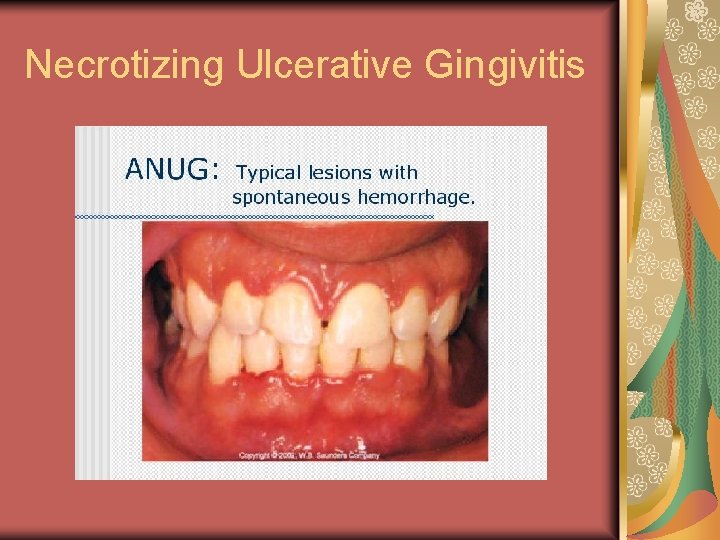 Necrotizing Ulcerative Gingivitis 