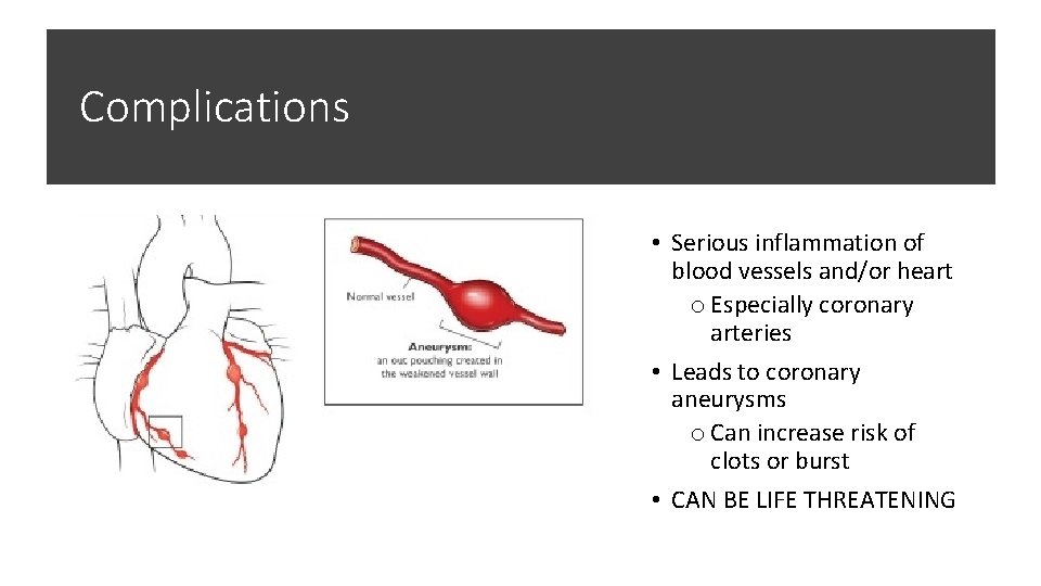 Complications • Serious inflammation of blood vessels and/or heart o Especially coronary arteries •