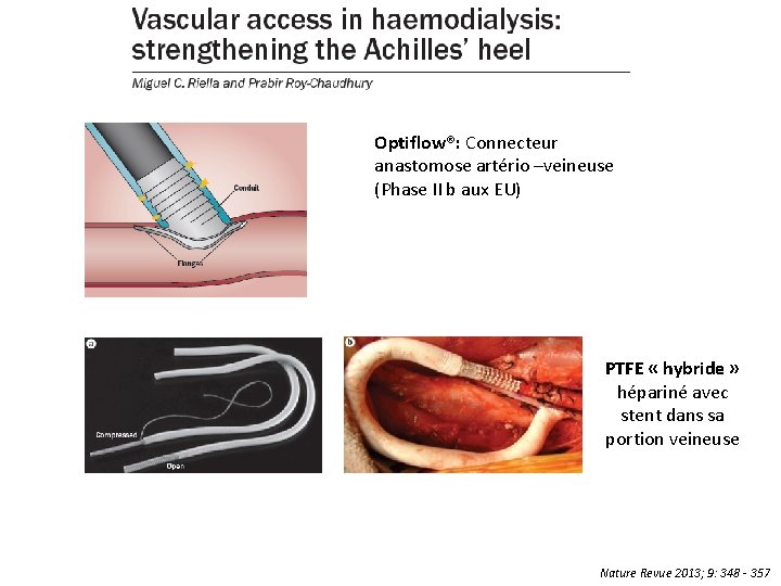 Optiflow®: Connecteur anastomose artério –veineuse (Phase II b aux EU) PTFE « hybride »