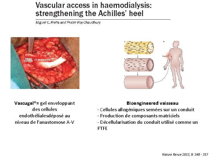 Vascugel®= gel enveloppant des cellules endothélialesdéposé au niveau de l’anastomose A-V Bioengineered vaisseau -