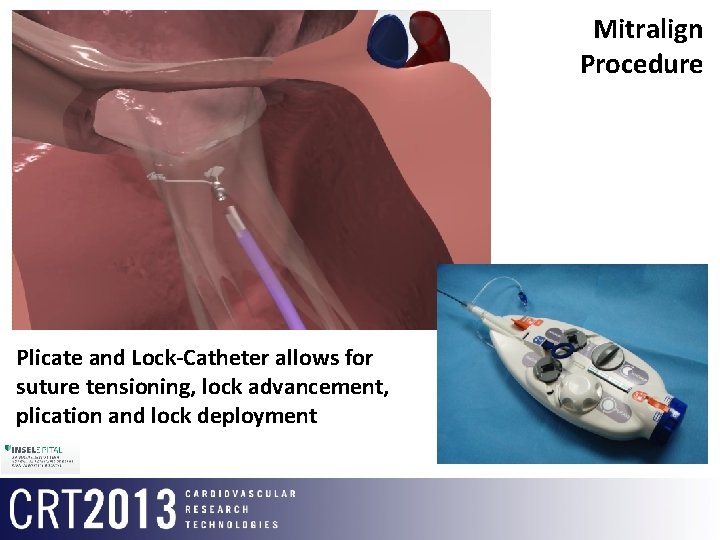 Mitralign Procedure Plicate and Lock-Catheter allows for suture tensioning, lock advancement, plication and lock