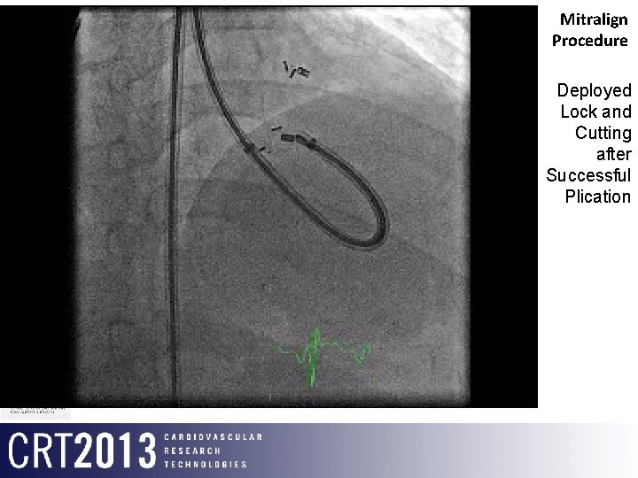 Mitralign Procedure Deployed Lock and Cutting after Successful Plication 