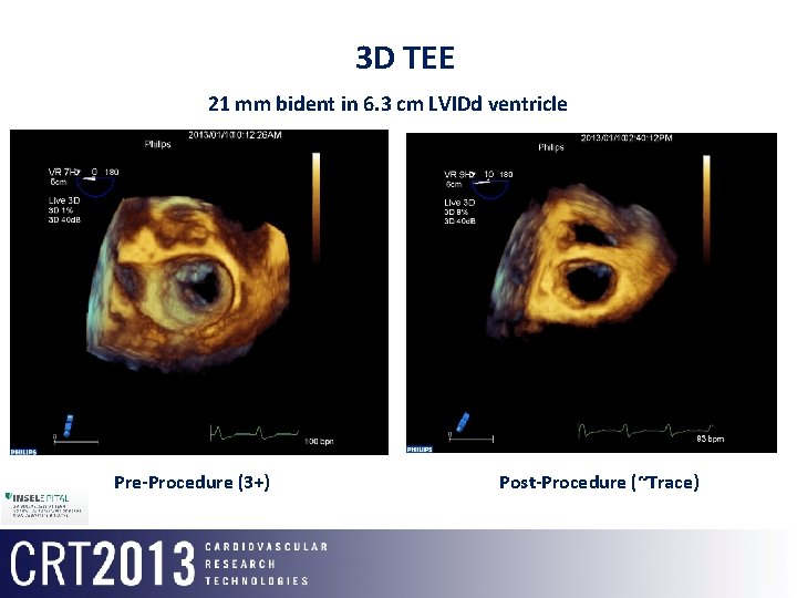 3 D TEE 21 mm bident in 6. 3 cm LVIDd ventricle Pre-Procedure (3+)