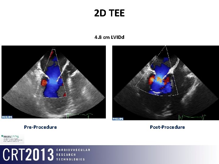 2 D TEE 4. 8 cm LVIDd Pre-Procedure Post-Procedure 