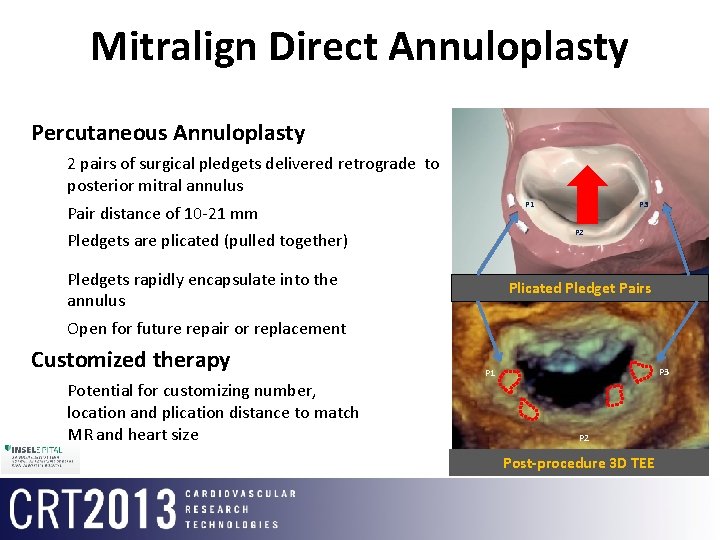 Mitralign Direct Annuloplasty Percutaneous Annuloplasty 2 pairs of surgical pledgets delivered retrograde to posterior