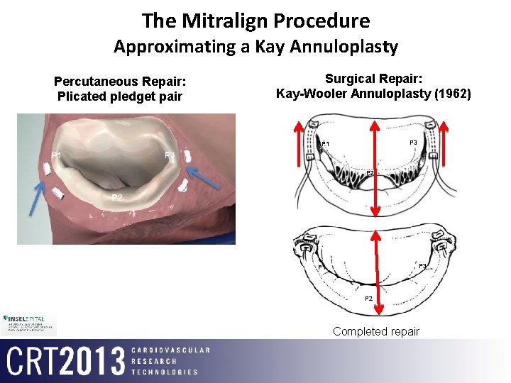 The Mitralign Procedure Approximating a Kay Annuloplasty Percutaneous Repair: Plicated pledget pair Surgical Repair: