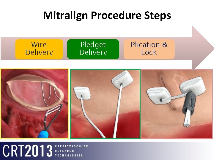 Mitralign Procedure Steps Wire Delivery Pledget Delivery Plication & Lock 